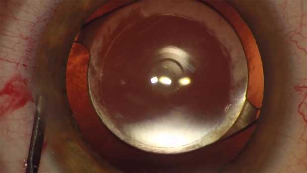 lentes intraoculares toricas alcon